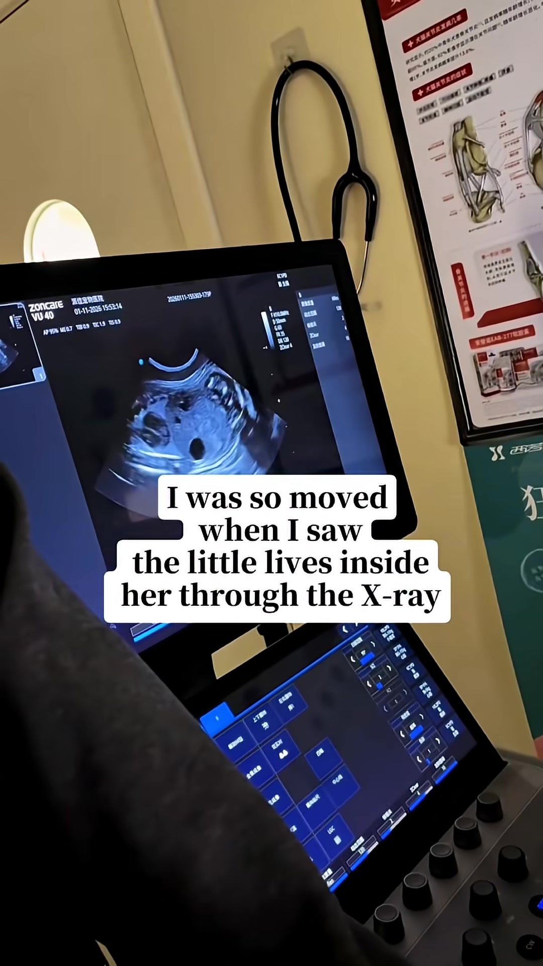 An ultrasound image showing kittens inside a cat's womb.