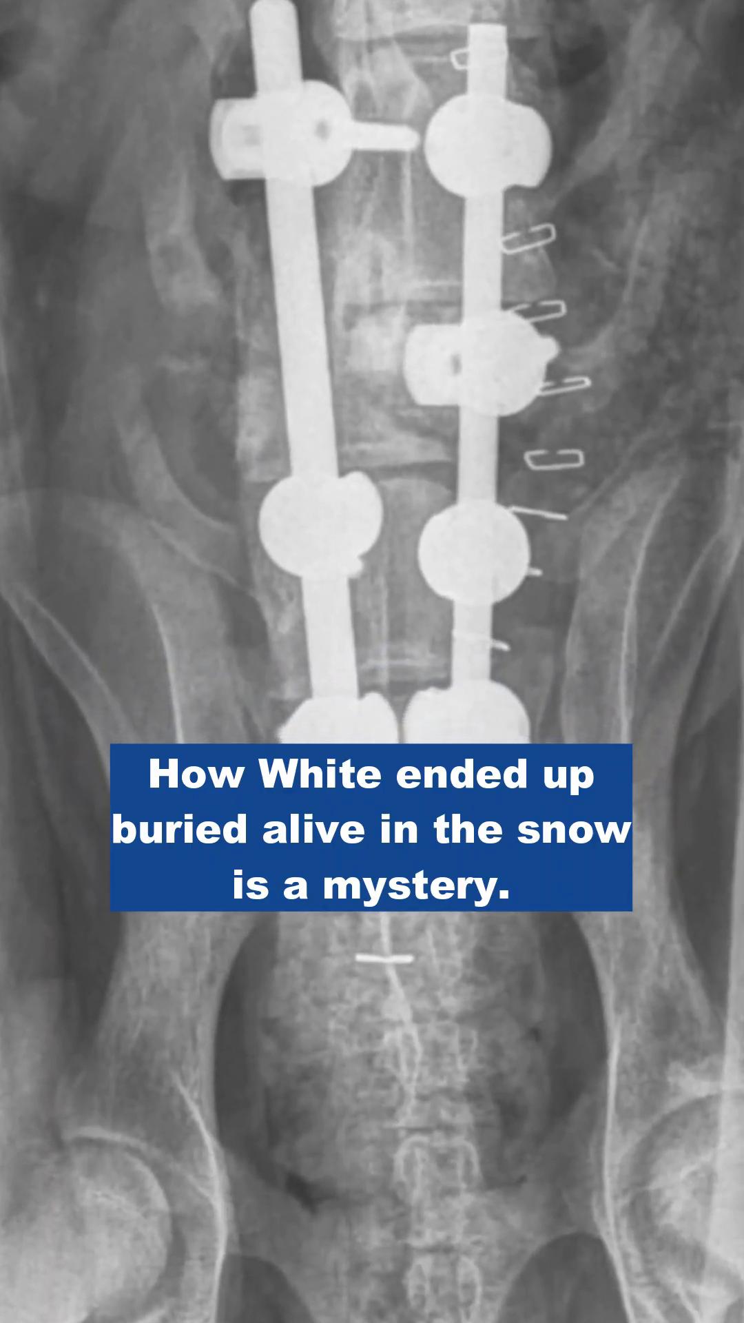 An X-ray showing a dog's spine with surgical implants.